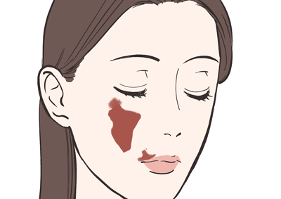赤あざ