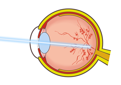 網膜光凝固術